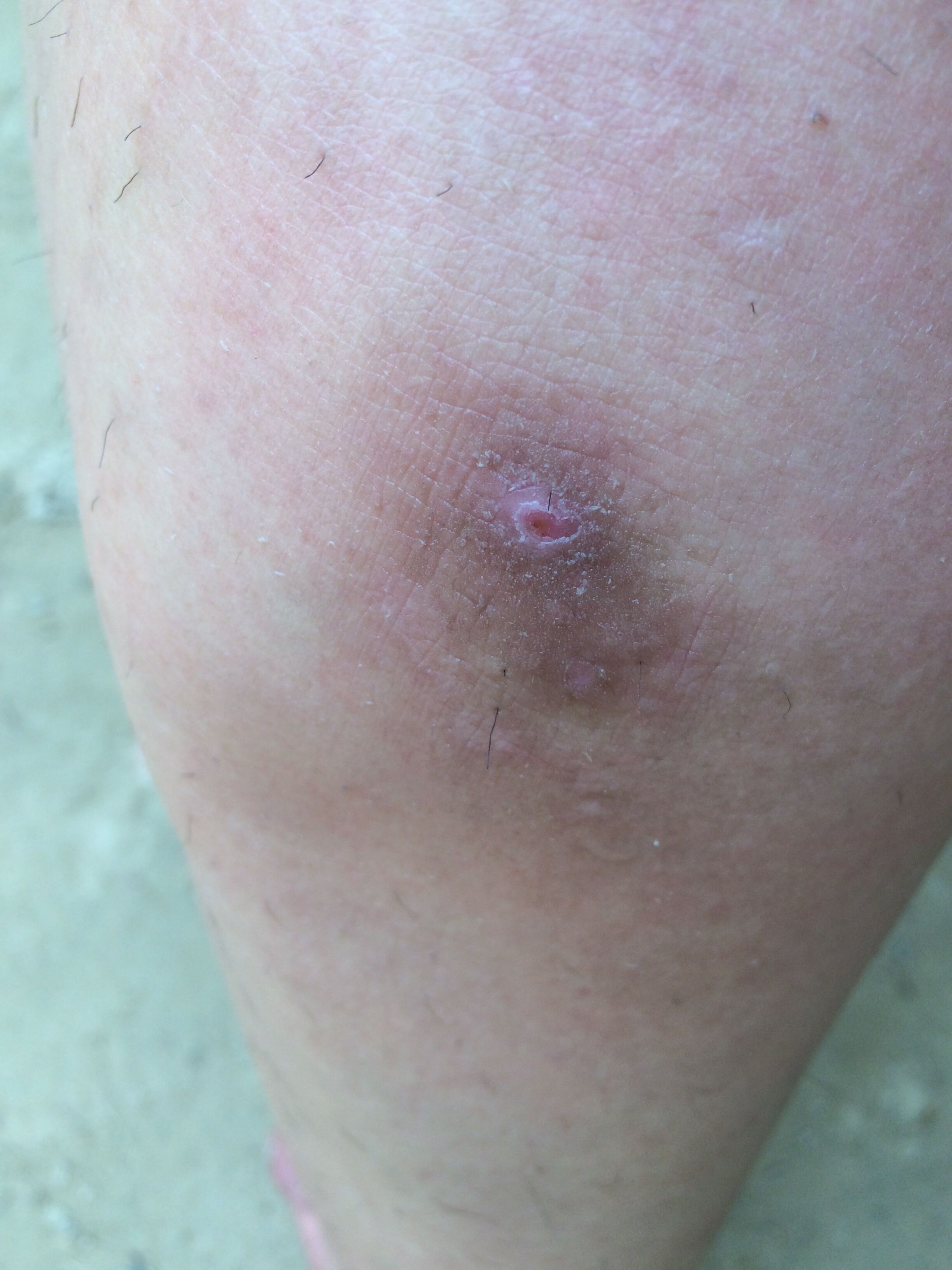 我左小腿上在一年前突然长了一块褐色的斑,不疼不痒,但是很难看