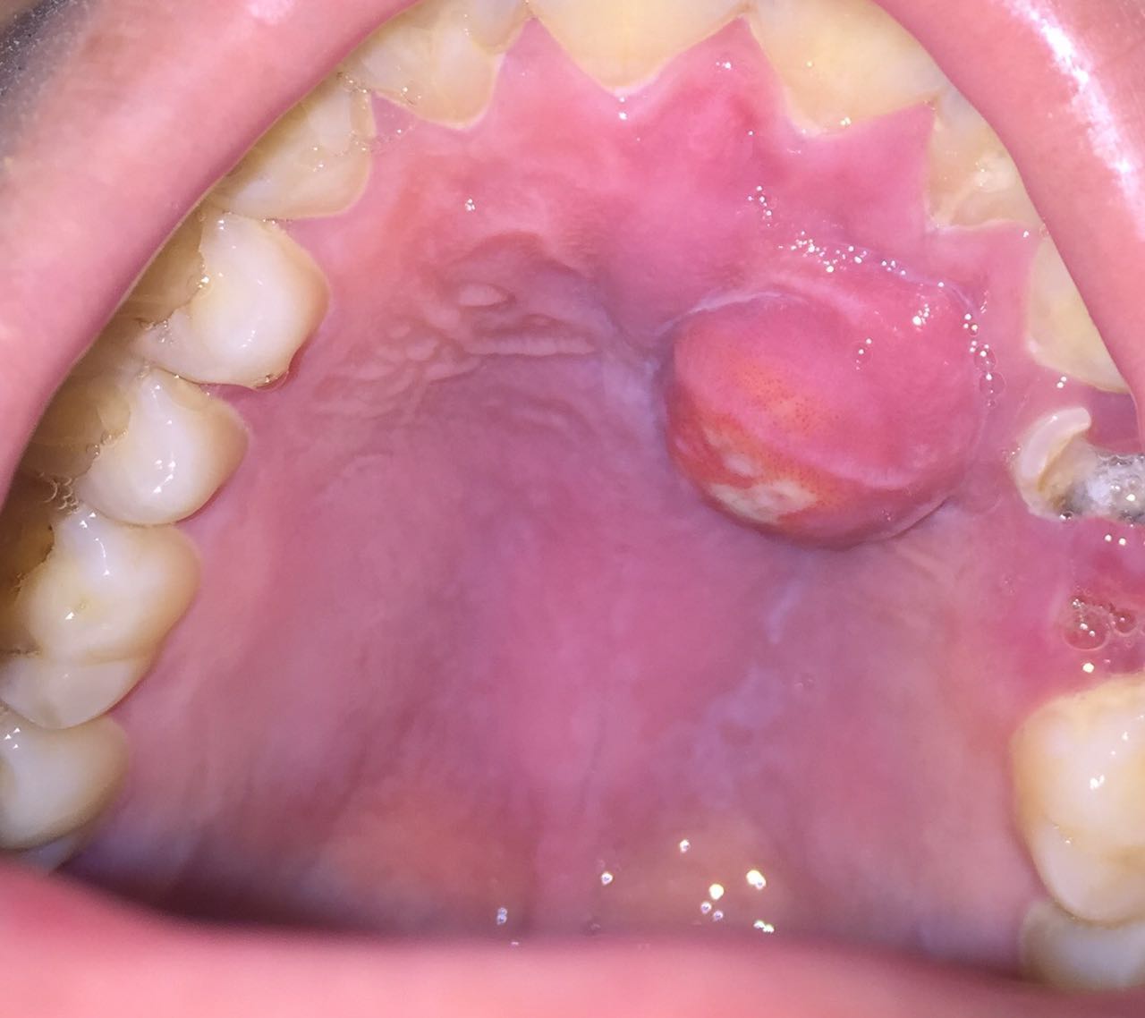 牙槽黏膜发炎图片