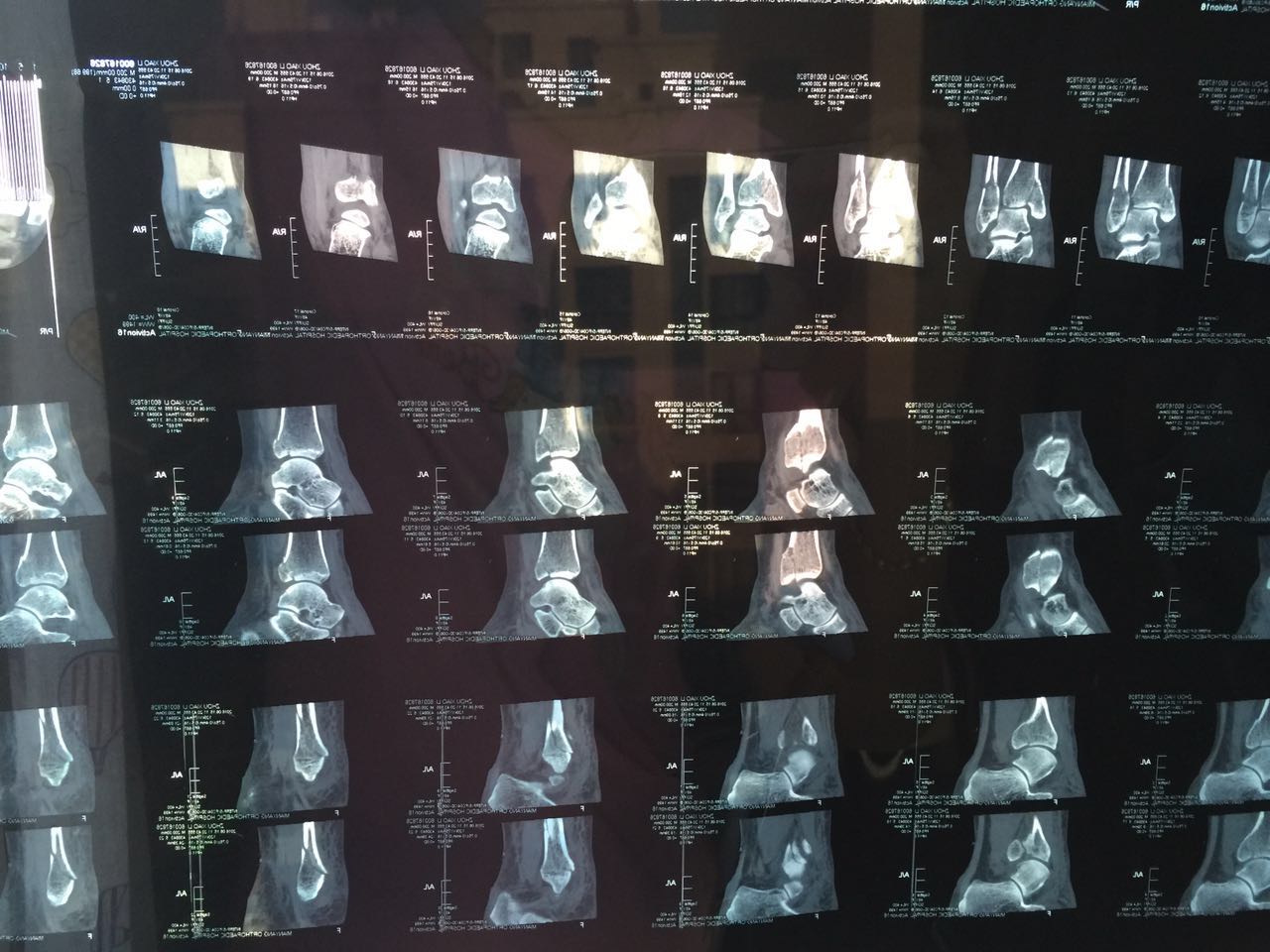 ct檢查報告單左脛骨下端內踝後踝及外踝骨折斷端分離