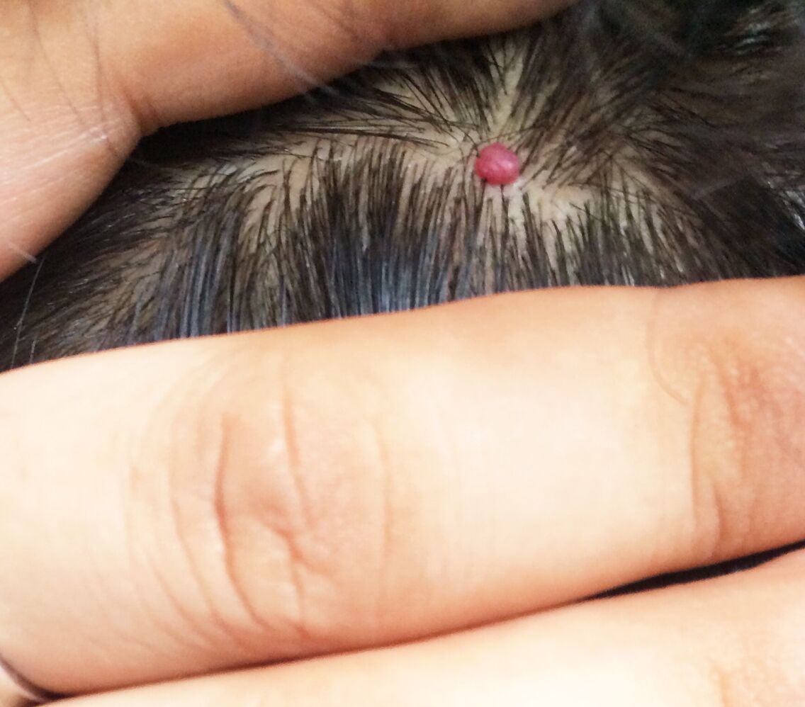 头皮紫色素瘤早期图片图片