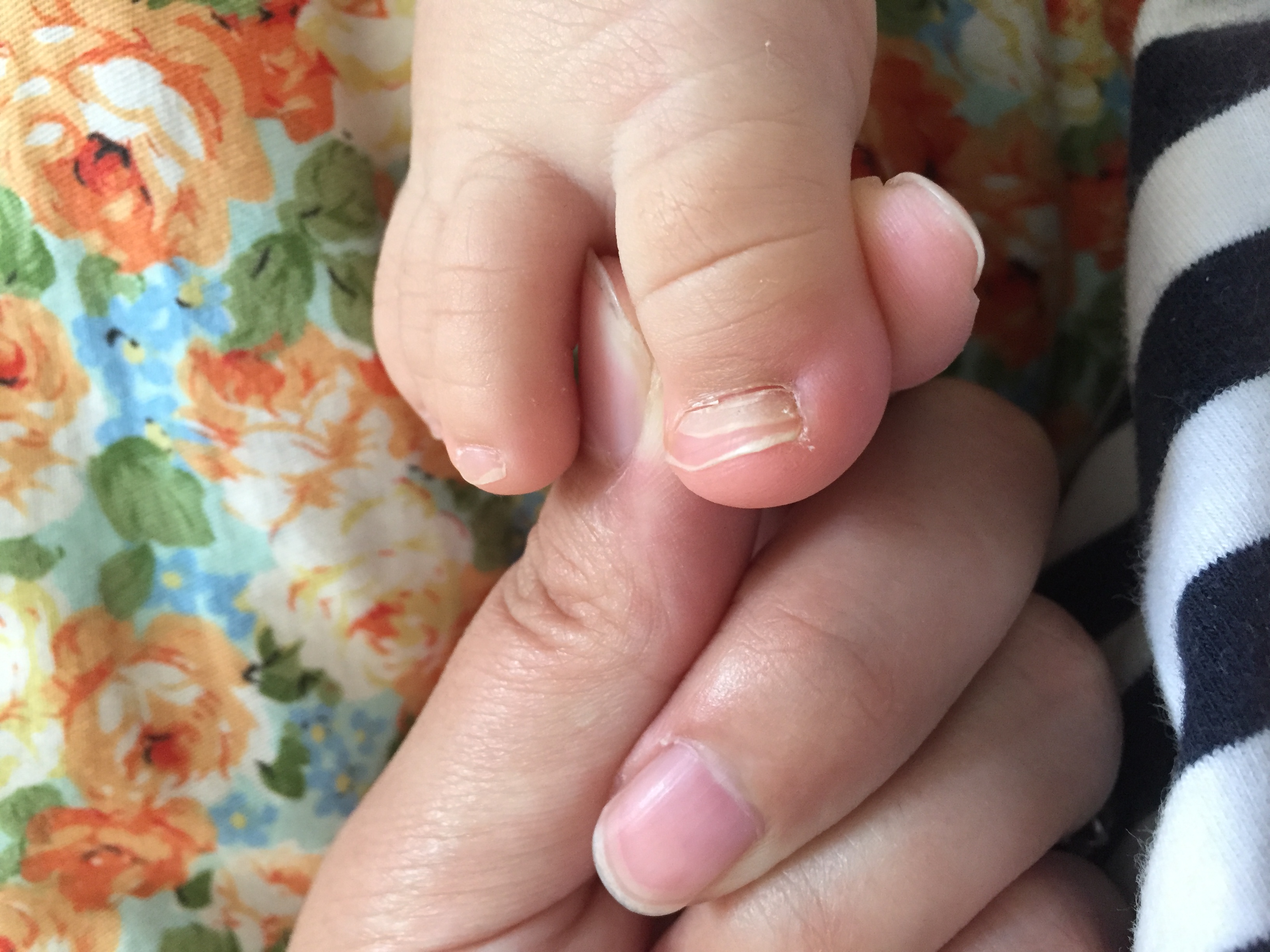 宝宝现在11个月突然发现她的脚指甲好像空了一块想知道是什么原