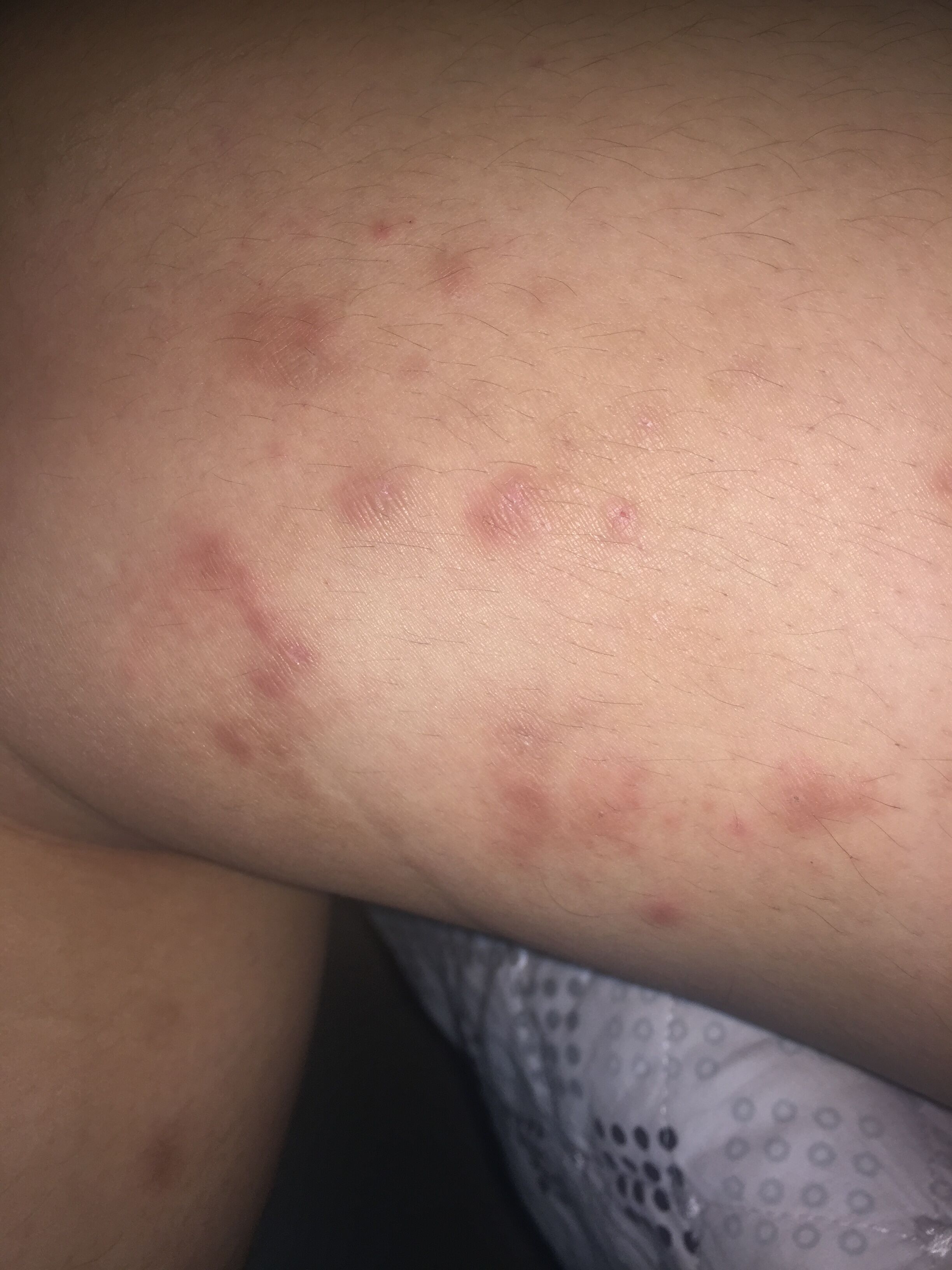 大腿长了很多红色的小痘痘,有一个月左右了.一开始只是很痒,没
