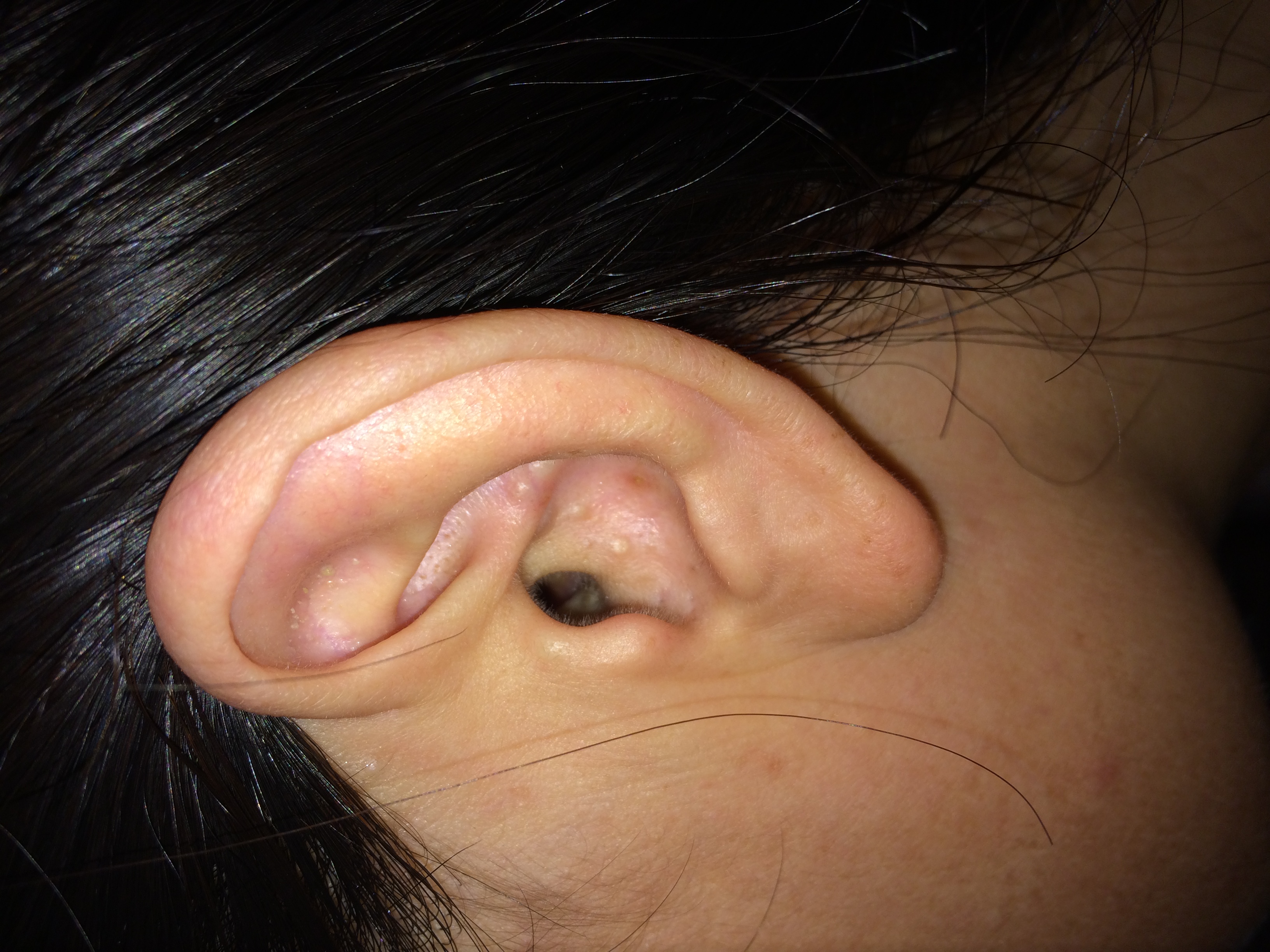外耳道长白色颗粒图片图片