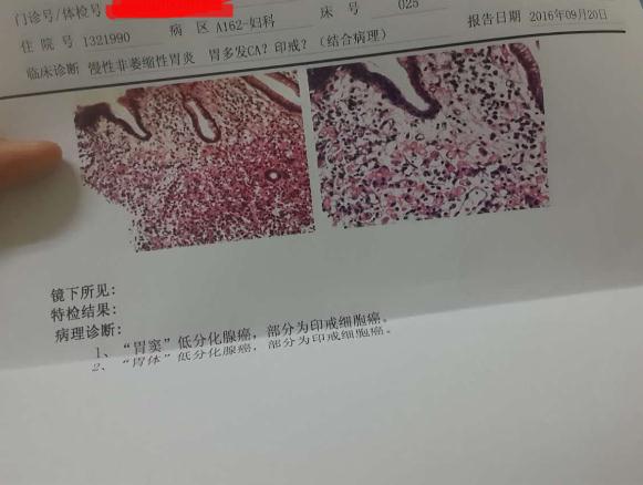 胃窦胃体低分化腺癌部分印戒细胞癌刚刚开始以为是妇科肿瘤在