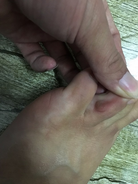 脚趾头缝里面起了一个小痘痘走路的时候磨到会痛感觉像是茧子