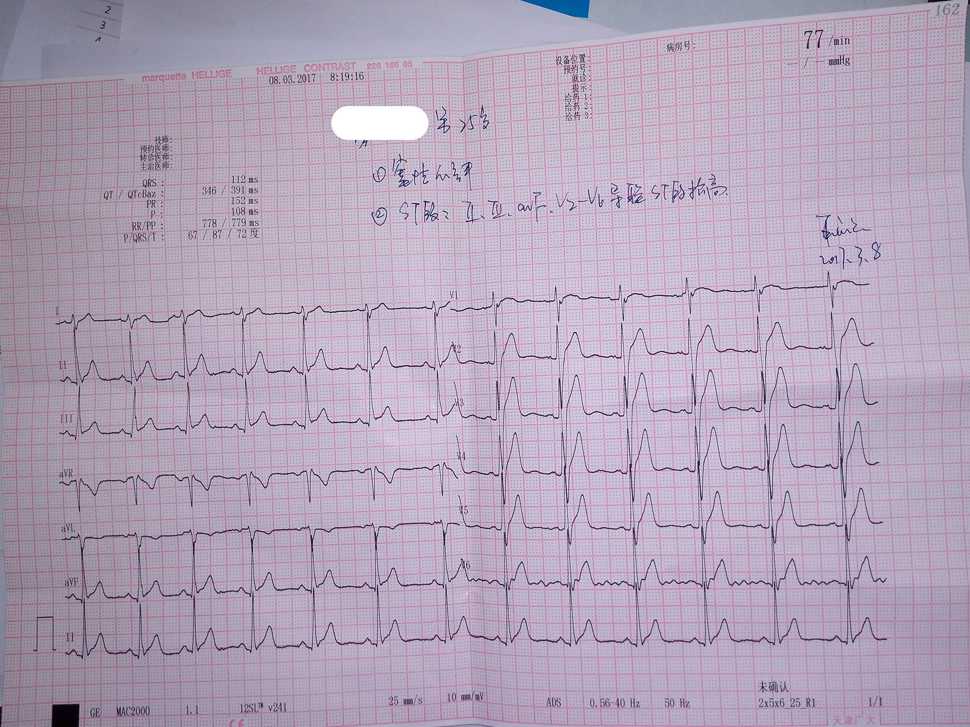 在医院检查心电图显示窦性心律iiiiiawfv2