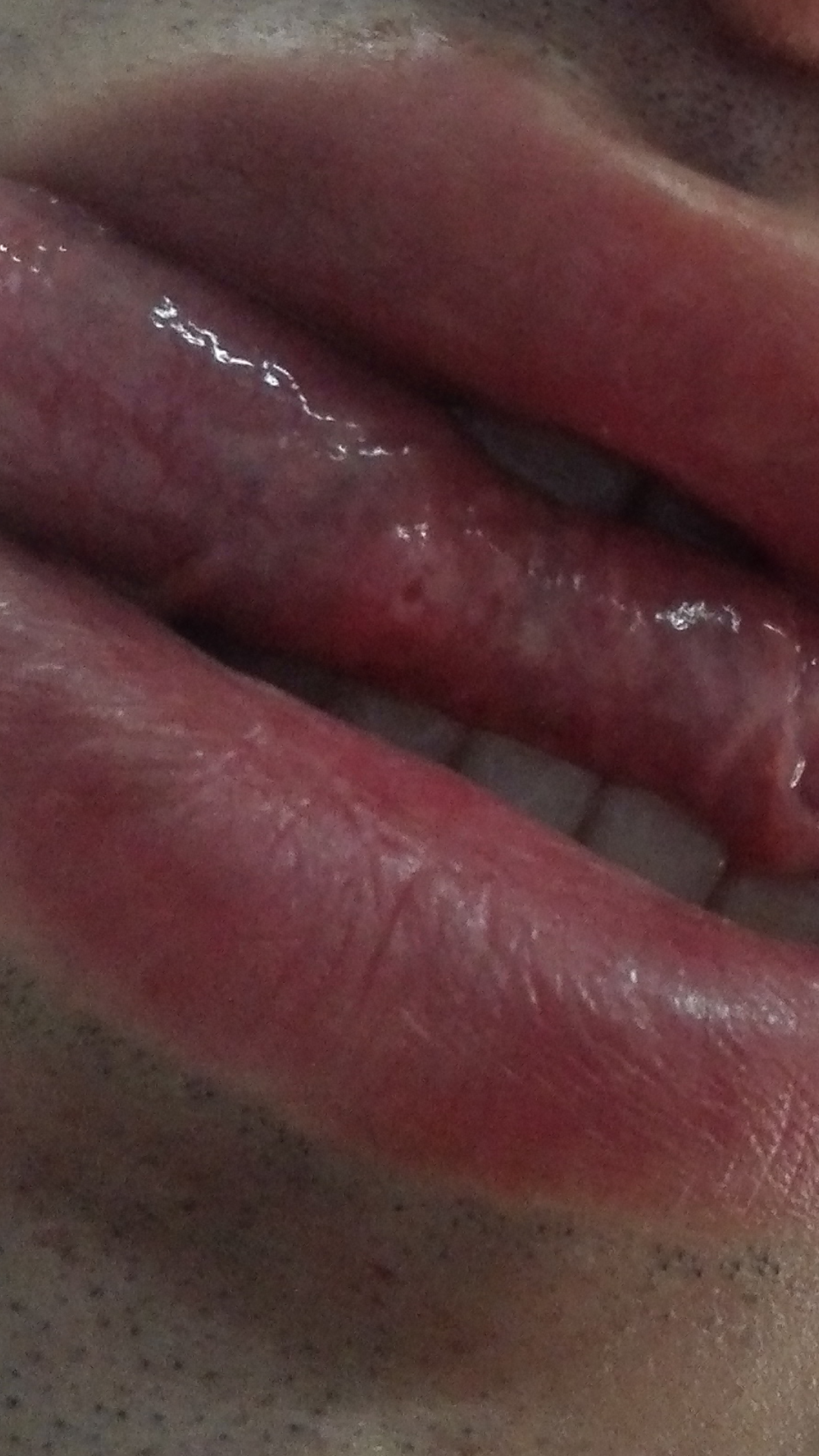舌头下面疱疹图片