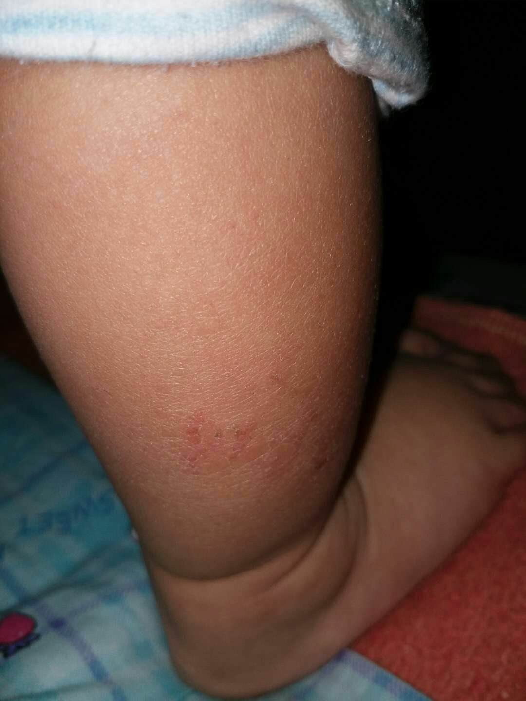 宝宝腿上说是湿疹结果用了炉甘石感觉严重了麻烦看看这是