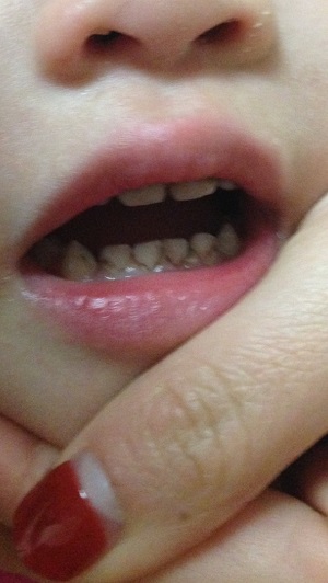 我女儿一岁半左右开始最先牙齿有点黄有点透明现在慢慢变黑现在刚