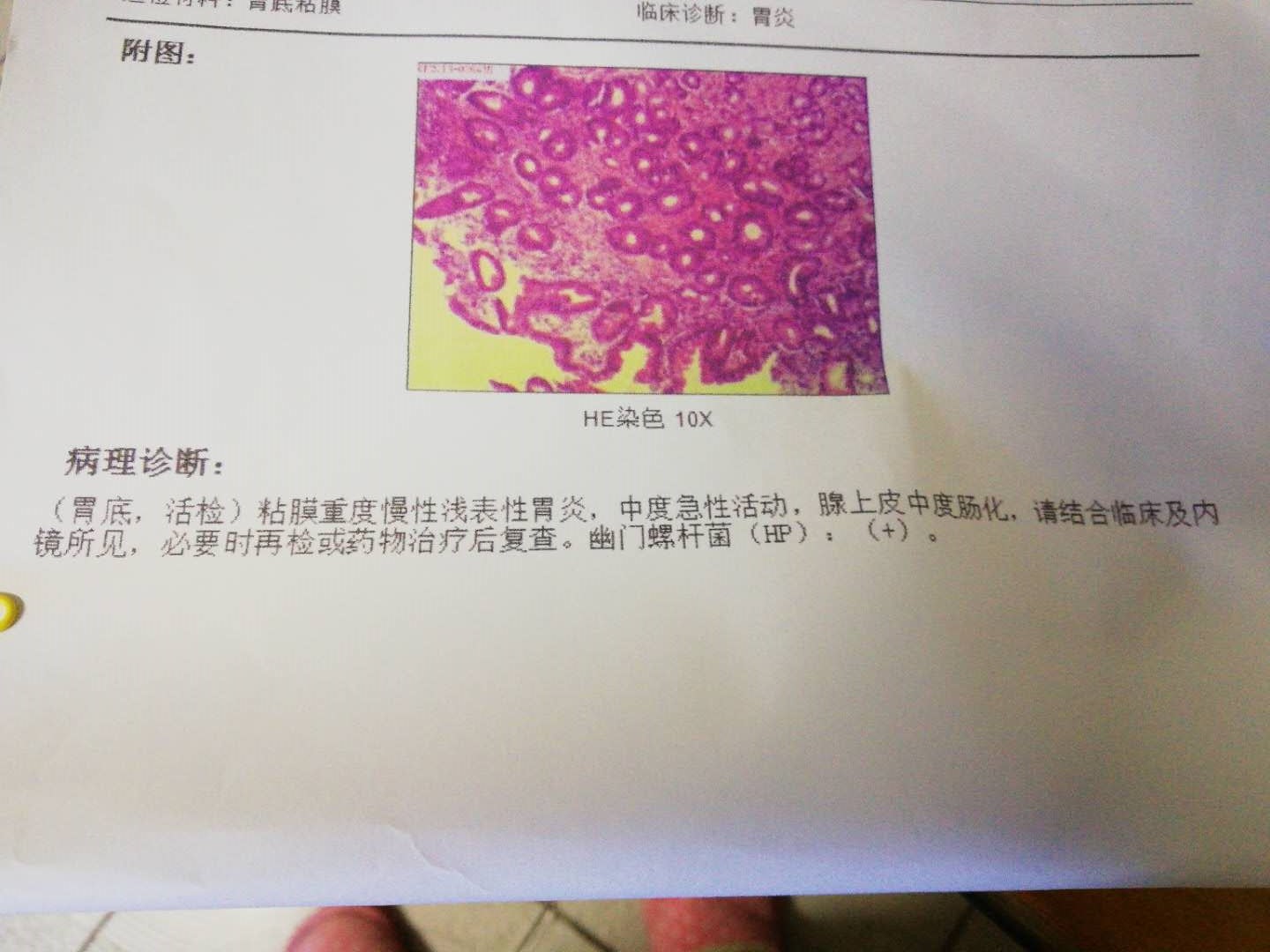 食道癌活检报告图片图片