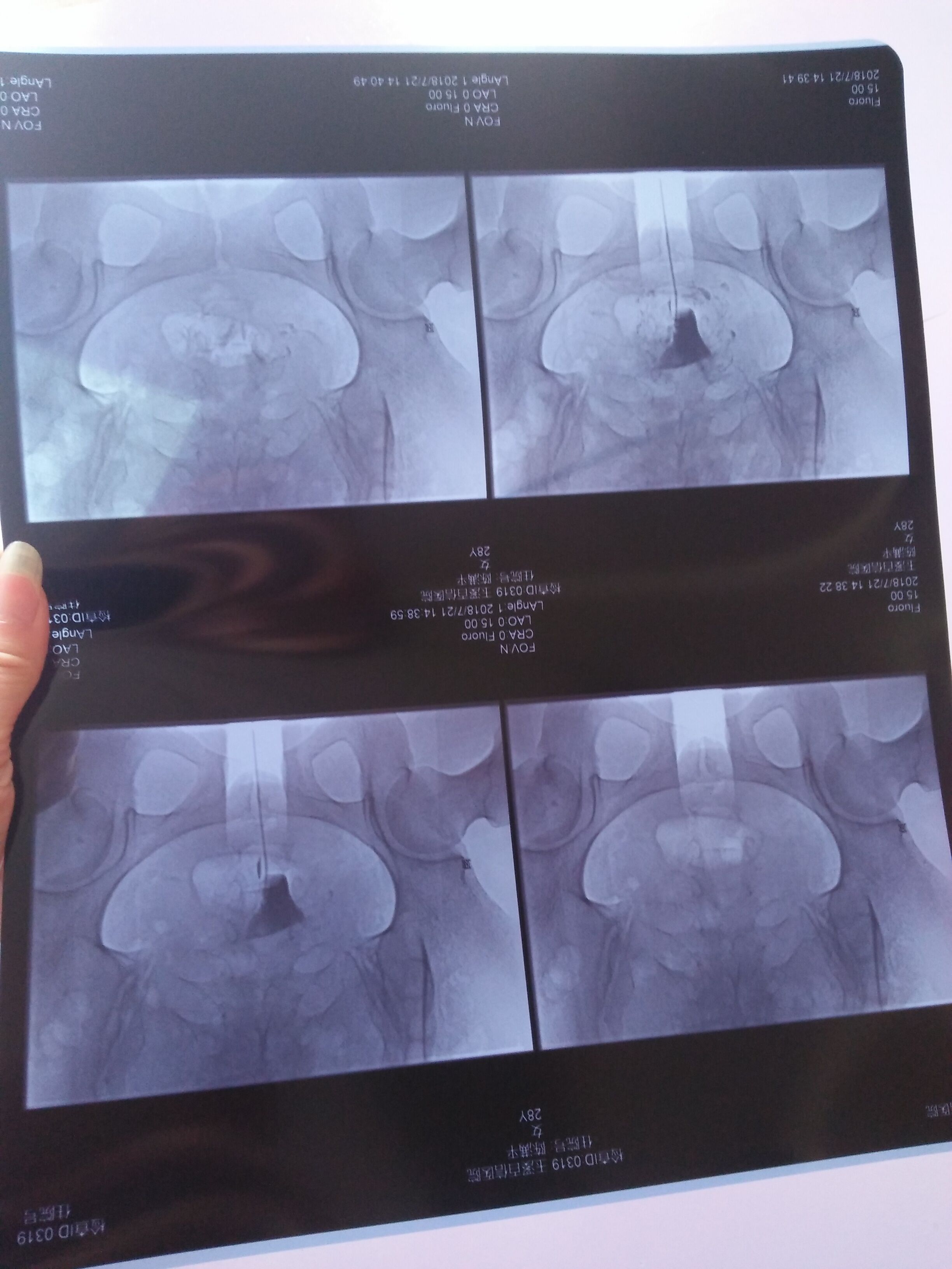 2015年9月份做過一次腹腔鏡宮外孕手術當時切了一邊只有