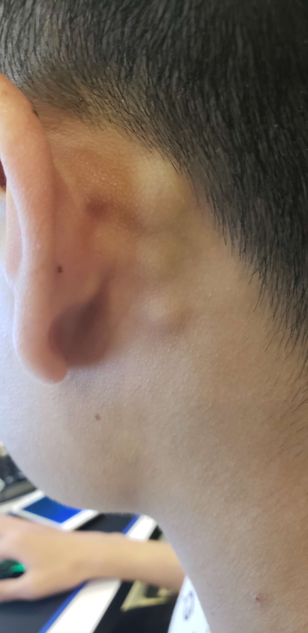 耳朵后面的淋巴结图片