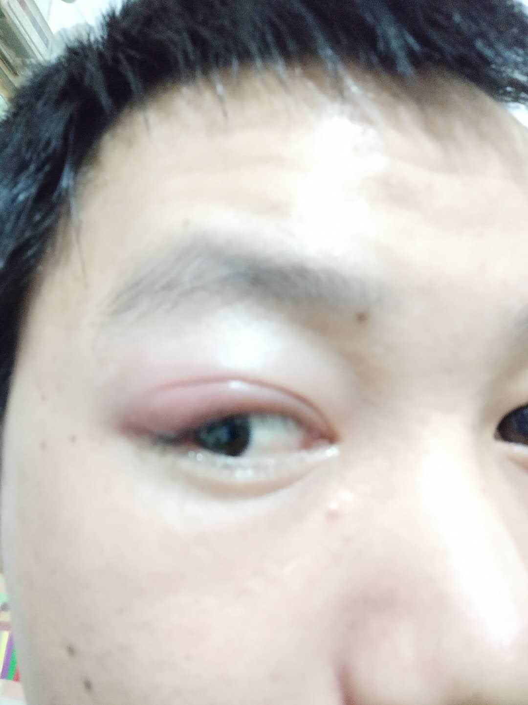 左眼外眼皮疼肿周二开始的刚开始只是疼第二天开始肿没有病史