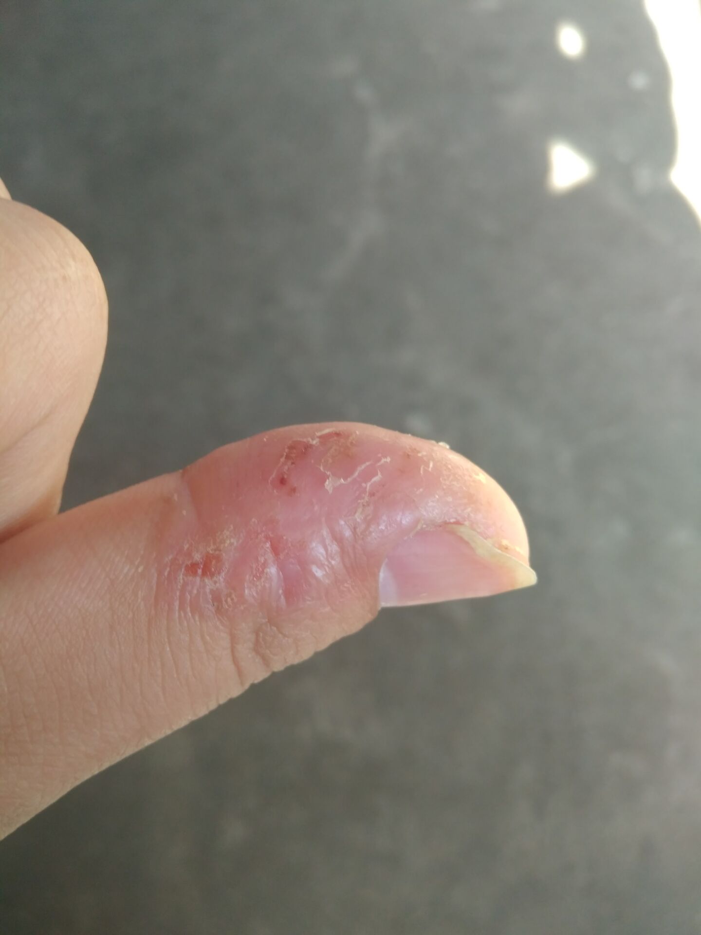 大概有4个月左右了刚开始在指甲缝有一个小白泡很痒白泡几破