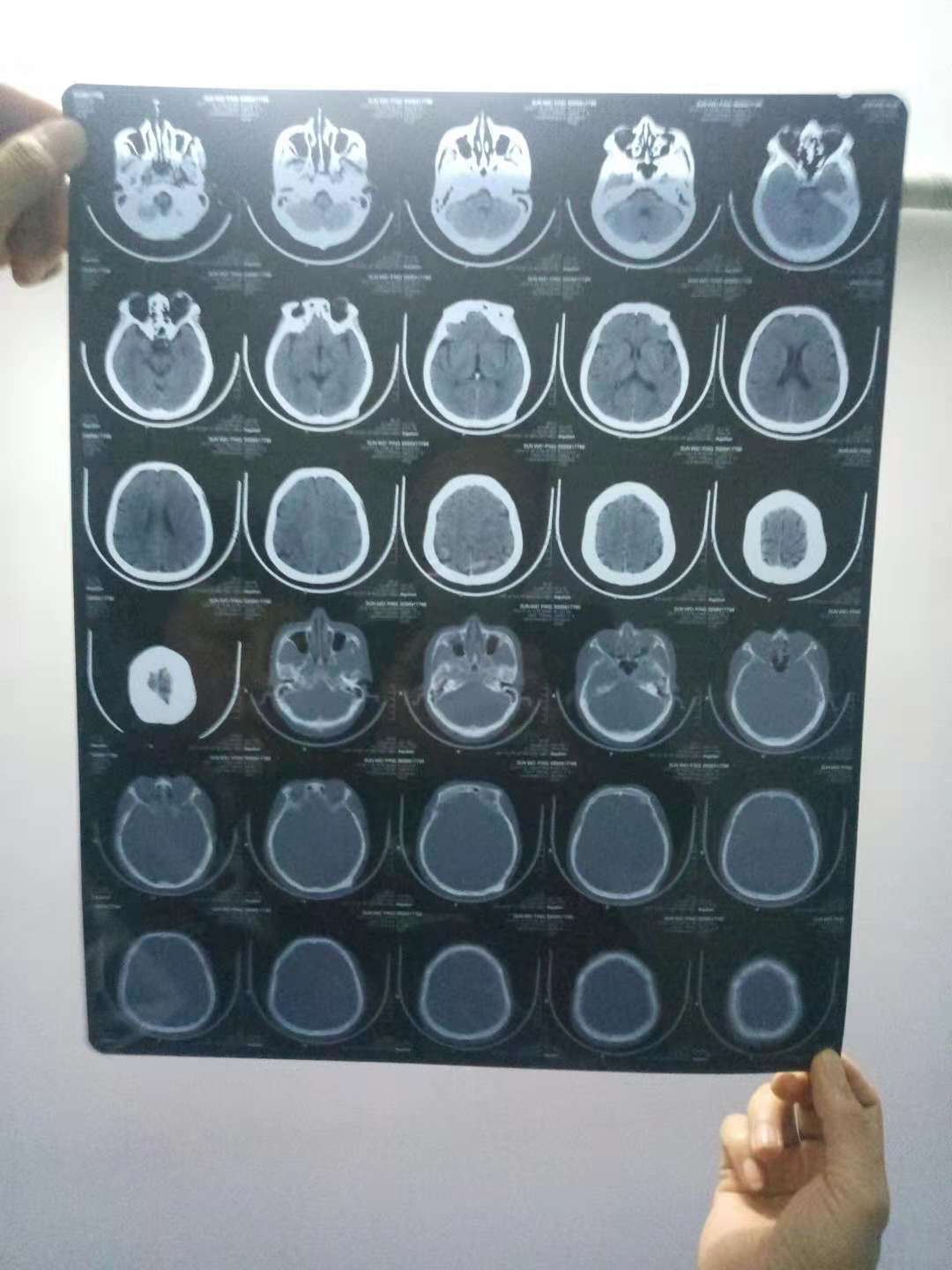 颅骨骨瘤早期症状照片图片
