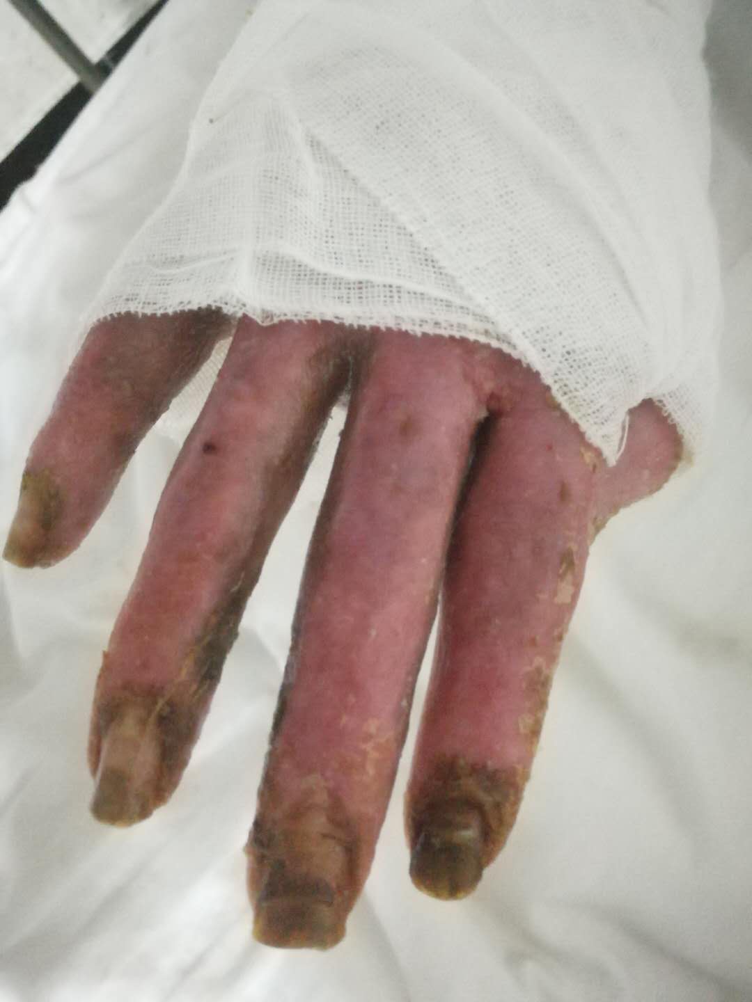 男,47岁,3月前汽油烧伤十根手指无法弯曲,末梢处疼痛难忍