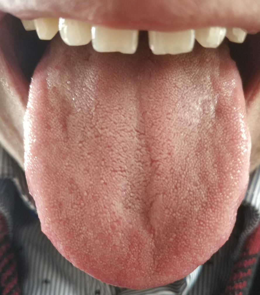 肾不好的舌头图图片