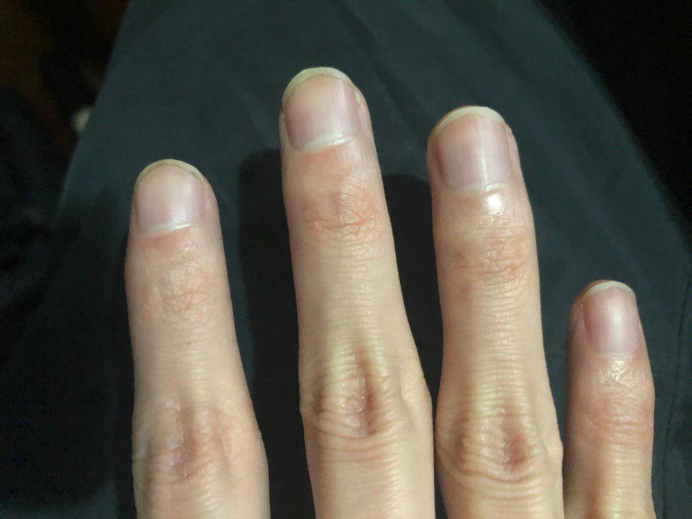 手指第一个关节有凸起,肥大,已有数日坐胸口按压会有疼痛感