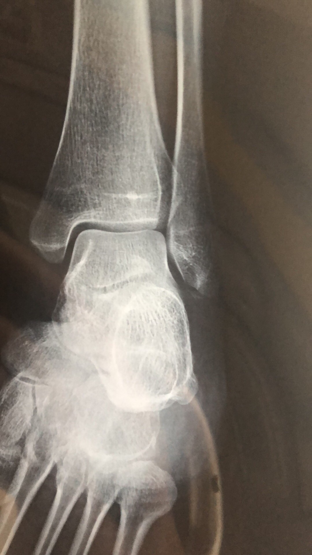 左外踝脚踝撕脱骨折25天支具固定无其他不良反应