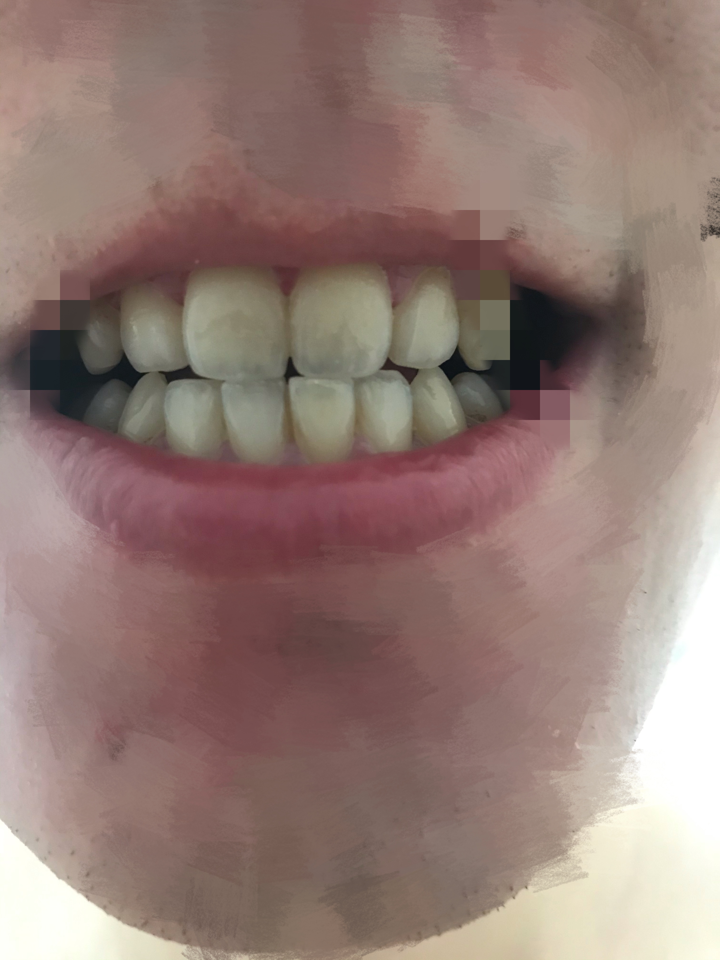 门牙下端透明图片