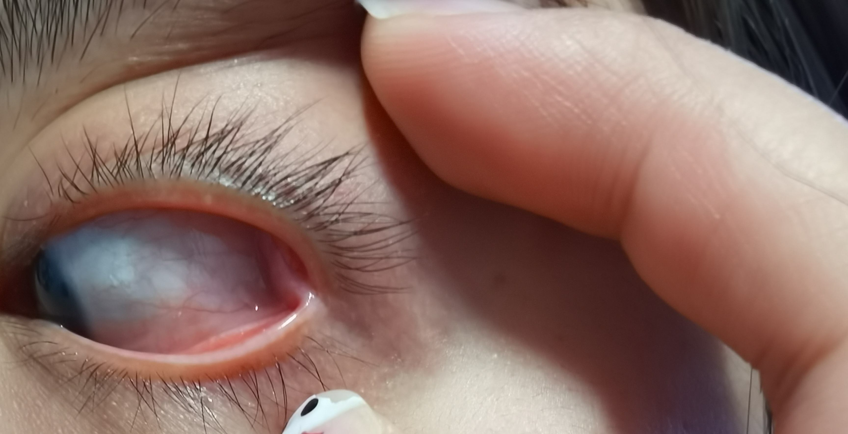 球结膜长期水肿红血丝长期不退有近3个月了眼睛往左右看