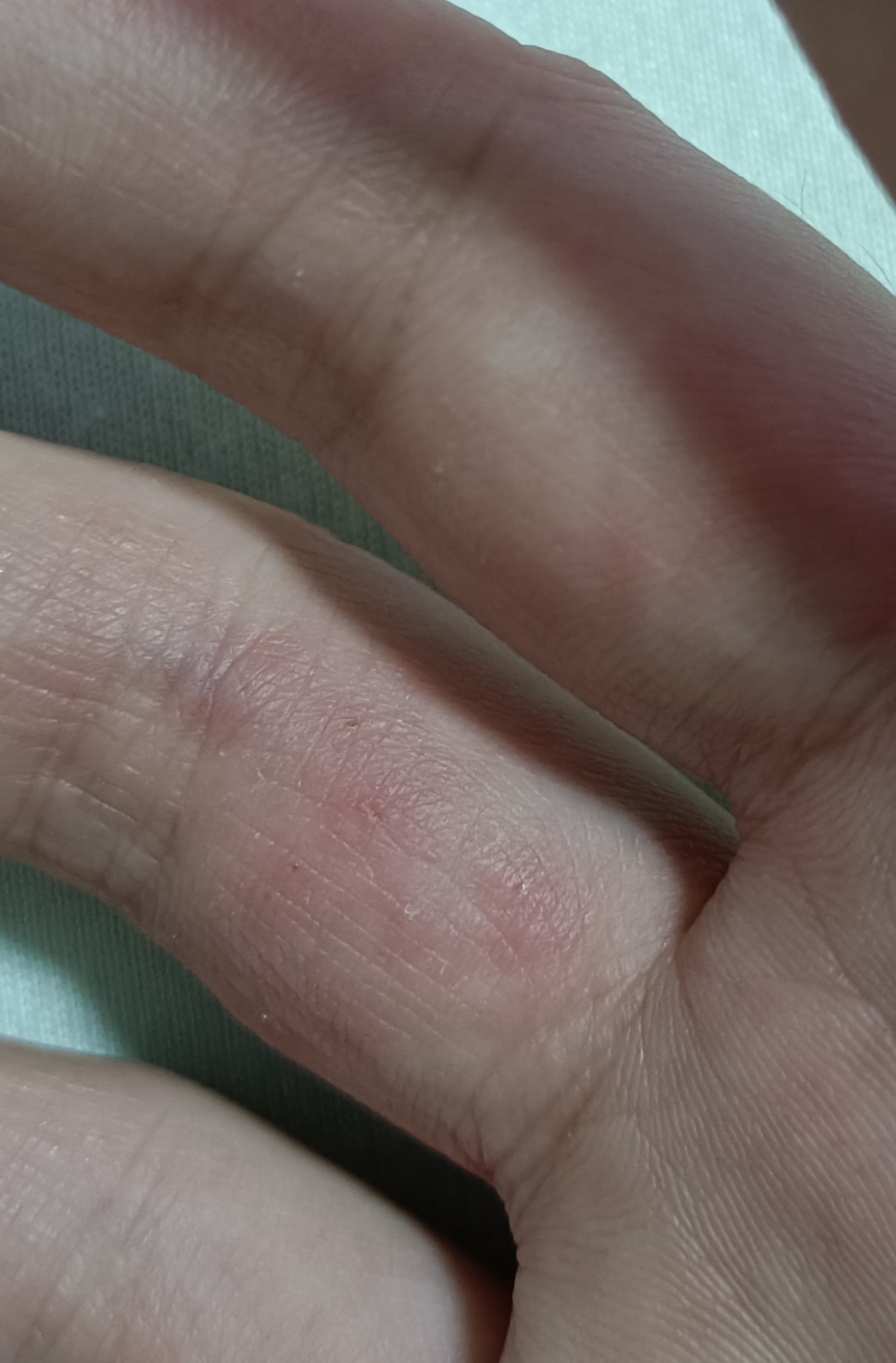 双手手指湿疹,关节处尤为严重,有水泡,很痒,已经三年,每年夏_其他科室